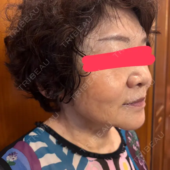 RF（高周波）たるみ治療 共立美容 池袋院 DAY 45 メイン用