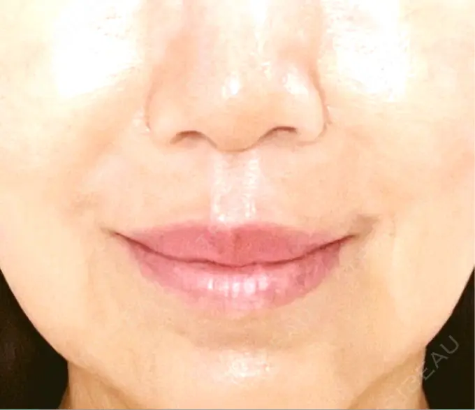 小鼻縮小（切開） / 人中短縮 Otus Clinic 【オータスクリニック】 AFTER メイン用