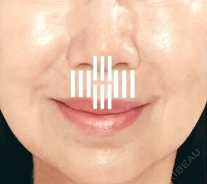 小鼻縮小（切開） / 人中短縮 Otus Clinic 【オータスクリニック】 DAY 799 メイン用