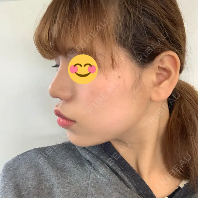 隆鼻術 / 鼻尖形成（切開） / 小鼻縮小（切開） / 軟骨移植 湘南美容クリニック 新橋銀座口院 DAY 56 メイン用