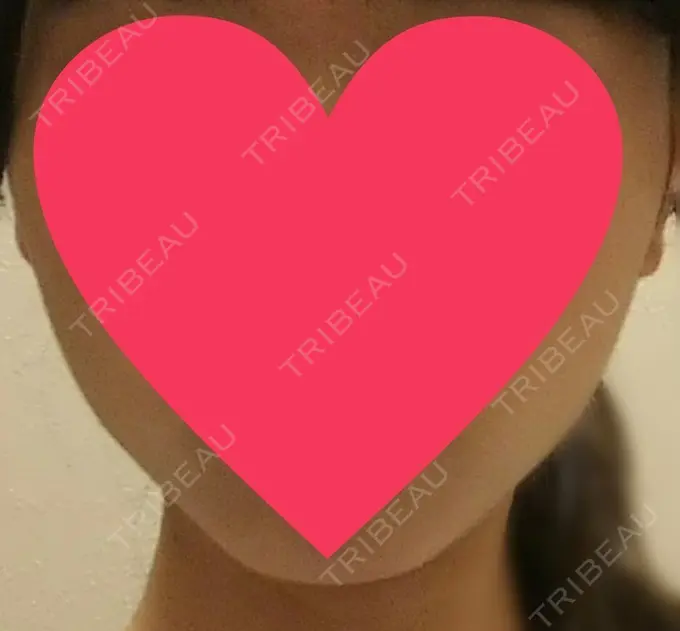 ハイフ（顔） 赤坂プレミアクリニック DAY 16 メイン用