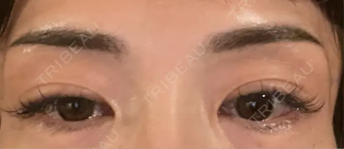 アートメイク（眉） 湘南AGAクリニック 大阪院 DAY 8 メイン用