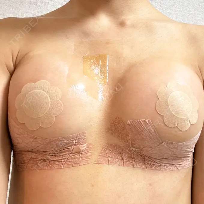 豊胸（シリコンバッグ） ルーチェクリニック 銀座院 DAY 71 メイン用