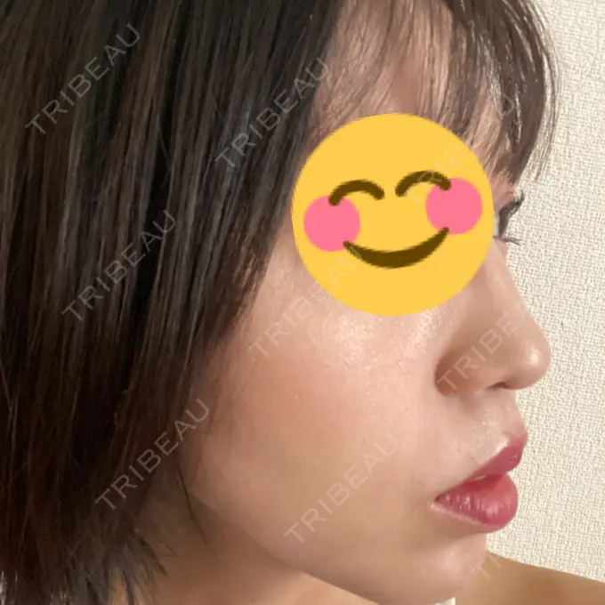 光治療（フォトフェイシャルなど） ミニマムスキンクリニック池袋 AFTER メイン用