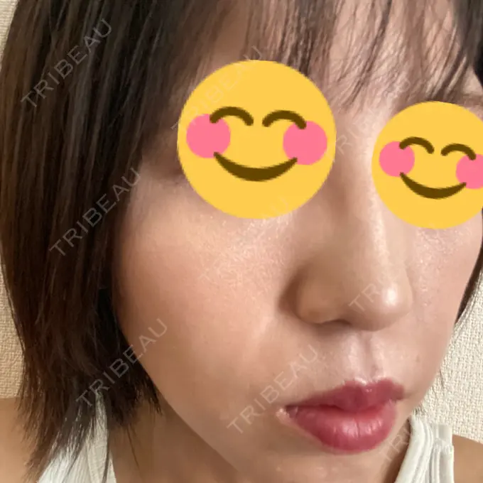 光治療（フォトフェイシャルなど） ミニマムスキンクリニック池袋 DAY 3 メイン用