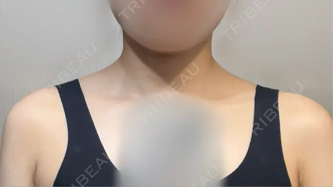 ボトックス（肩） ヴァージンクリニック 福岡天神院 DAY 2 メイン用