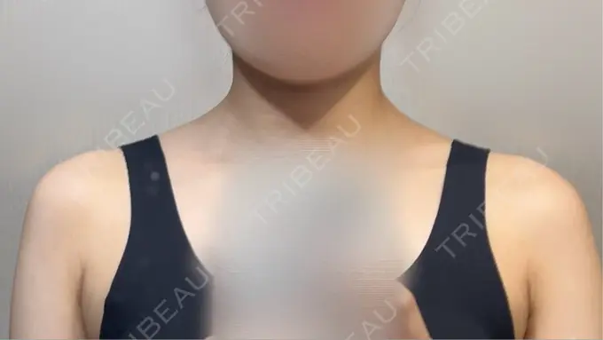 ボトックス（肩） ヴァージンクリニック 福岡天神院 DAY 4 メイン用