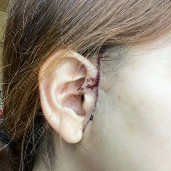 糸リフト / バッカルファット除去 / 脂肪吸引（顔） / 切開リフト / メーラーファット除去 / ジョールファット除去 A CLINIC（エークリニック） 銀座院 DAY 1 メイン用