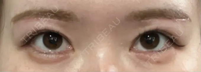 眉下切開 / ボトックス（眉間） / ボトックス（額） 銀座リシェスクリニック DAY 41 メイン用