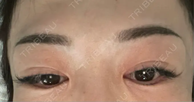 アートメイク（眉） 湘南AGAクリニック 大阪院 DAY 9 メイン用