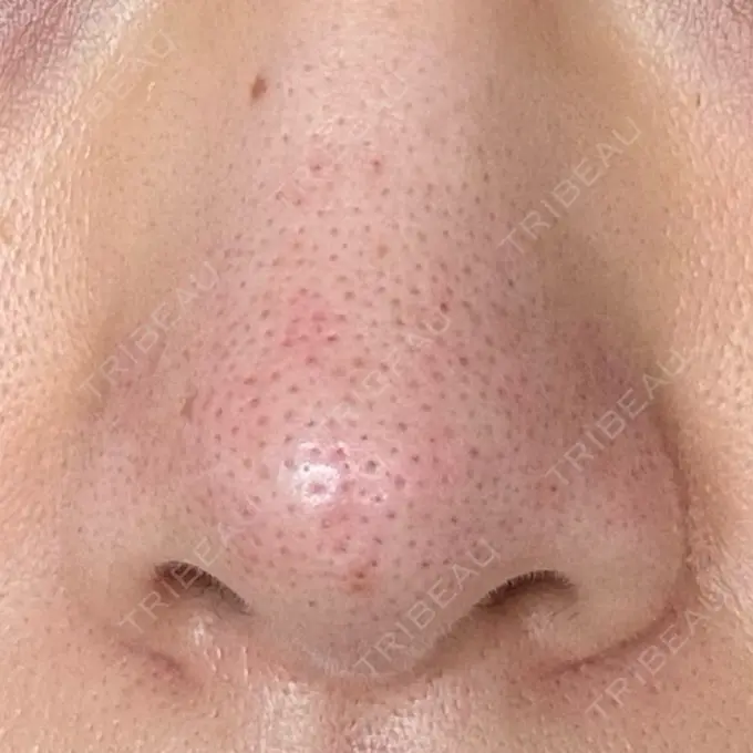 アグネス 日本美容・医療クリニック 六本木院 DAY 0 メイン用