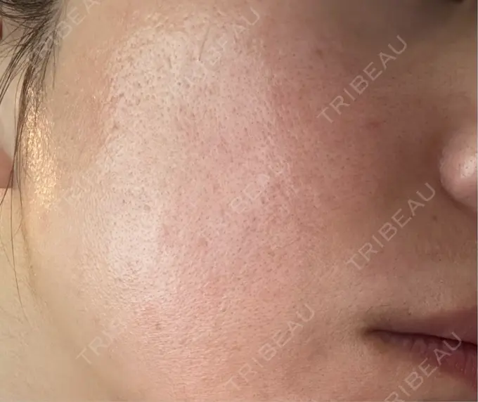 ピコレーザートーニング（美白・肝斑） / ピコフラクショナルレーザー（毛穴・ニキビ跡） おおかみ美容のクリニック 横浜院 AFTER メイン用