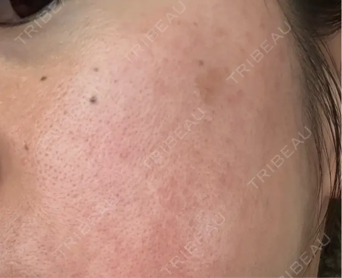 ピコレーザートーニング（美白・肝斑） / ピコフラクショナルレーザー（毛穴・ニキビ跡） おおかみ美容のクリニック 横浜院 DAY 8 メイン用