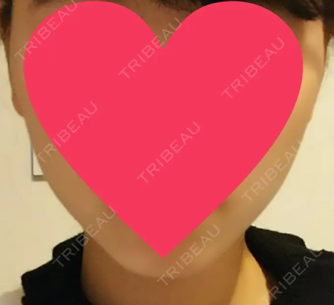 ハイフ（顔） 赤坂プレミアクリニック AFTER メイン用