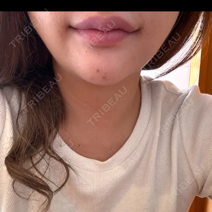 ヒアルロン酸注入（あご） / ボトックス（エラ・小顔） TCB東京中央美容外科 新宿東口院 DAY 0 メイン用