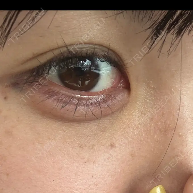 ヒアルロン酸注入（涙袋） 共立美容外科 熊本院 DAY 0 メイン用