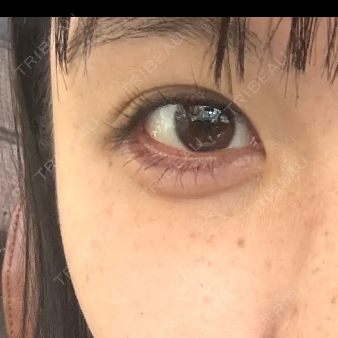 ヒアルロン酸注入（涙袋） 共立美容外科 熊本院 DAY 0 メイン用