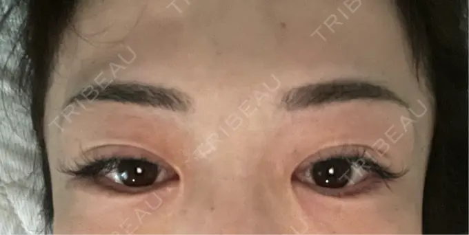 アートメイク（眉） 湘南AGAクリニック 大阪院 DAY 10 メイン用