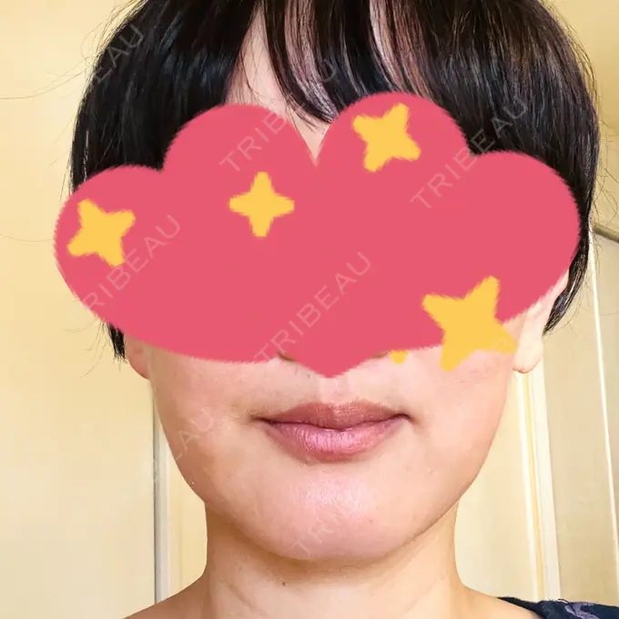 RF（高周波）たるみ治療 / その他（輪郭） DAILY SKIN CLINIC 心斎橋院 DAY 28 メイン用