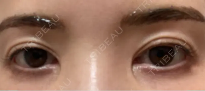 その他（目元） ルーチェクリニック 銀座院 DAY 1 メイン用