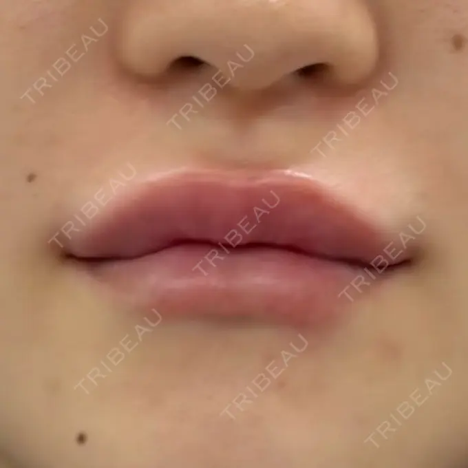 ヒアルロン酸注入（唇） 新未来クリニック DAY 1 メイン用