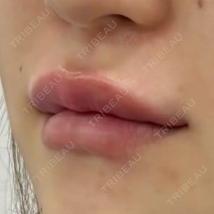 ヒアルロン酸注入（唇） 新未来クリニック DAY 1 メイン用