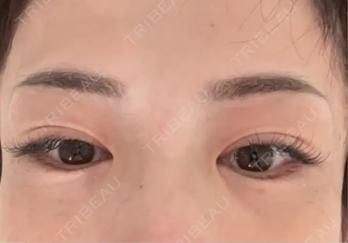 アートメイク（眉） 湘南AGAクリニック 大阪院 AFTER メイン用