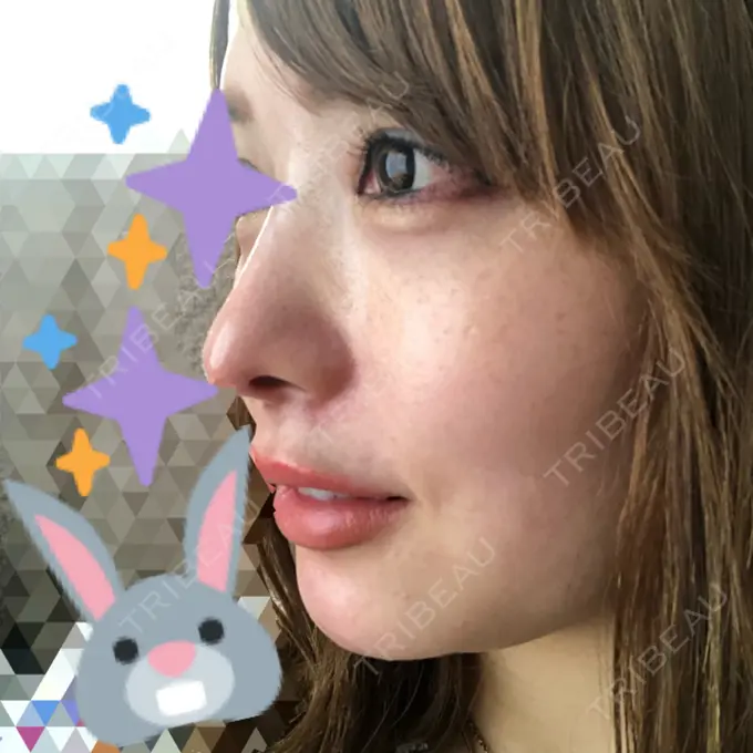 あごプロテーゼ / 輪郭修正 高崎TAクリニック DAY 28 メイン用