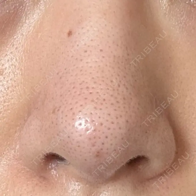 アグネス 日本美容・医療クリニック 六本木院 DAY 3 メイン用