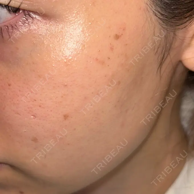 エレクトロポレーション / ルメッカ Grias clinic （ジリアスクリニック） AFTER メイン用