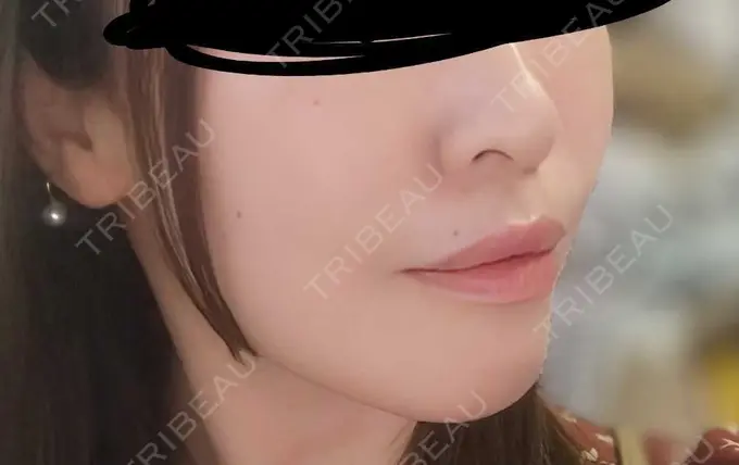 肌ヒアルロン酸注入（たるみ・シワ改善） / シワ取りボトックス 東京シルククリニック 新宿院 AFTER メイン用