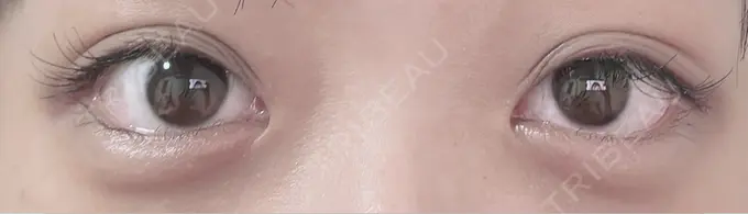 二重埋没 / ヒアルロン酸注入（涙袋） アリエル美容クリニック 横浜院 DAY 38 メイン用