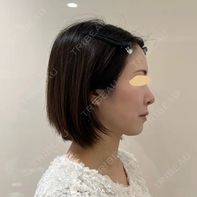 隆鼻術 / 軟骨移植 / 毛穴洗浄（ハイドラフェイシャルなど） / その他（鼻） BIANCA銀座 DAY 97 メイン用