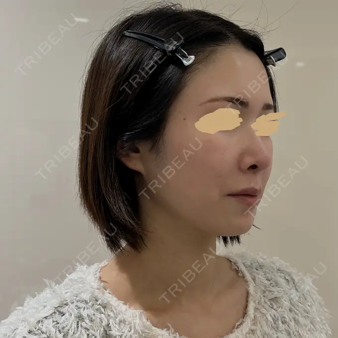 隆鼻術 / 軟骨移植 / 毛穴洗浄（ハイドラフェイシャルなど） / その他（鼻） BIANCA銀座 DAY 97 メイン用