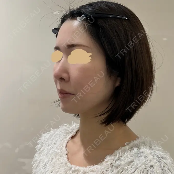 隆鼻術 / 軟骨移植 / 毛穴洗浄（ハイドラフェイシャルなど） / その他（鼻） BIANCA銀座 DAY 97 メイン用