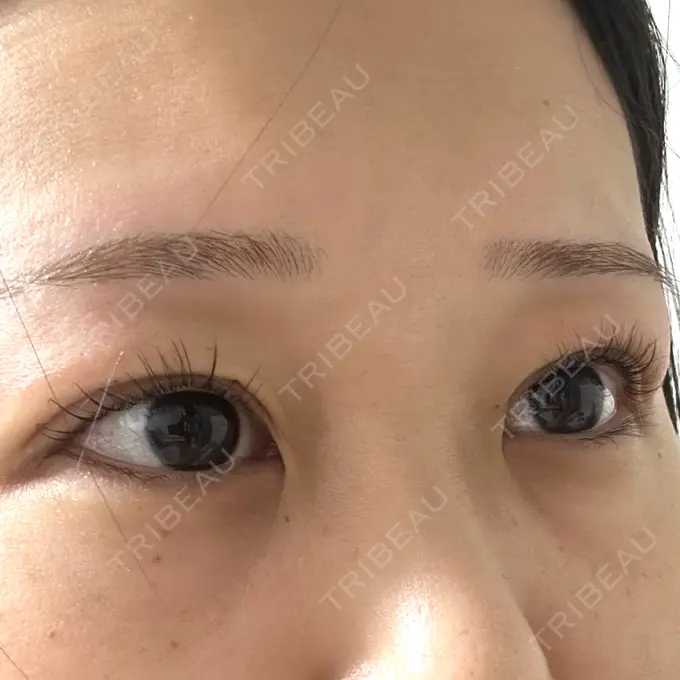 二重埋没 / 上まぶたの脂肪取り 共立美容外科 福岡院 DAY 0 メイン用