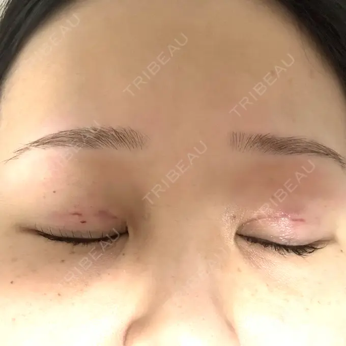 二重埋没 / 上まぶたの脂肪取り 共立美容外科 福岡院 DAY 0 メイン用