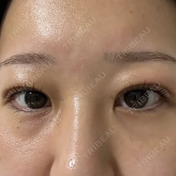 二重埋没 / 上まぶたの脂肪取り 共立美容外科 福岡院 DAY 1 メイン用