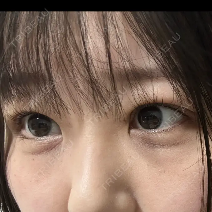 二重埋没 / 上まぶたの脂肪取り 共立美容外科 福岡院 DAY 1 メイン用