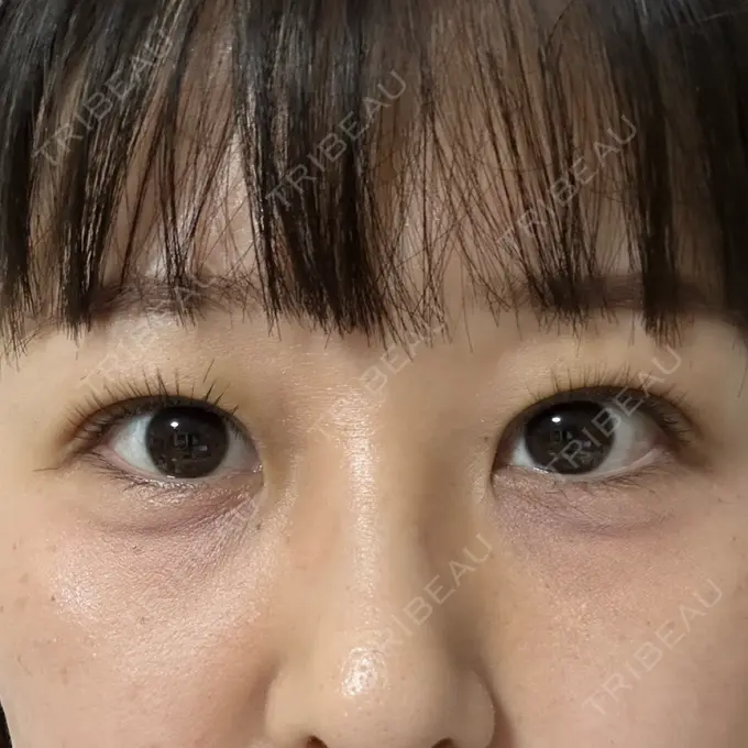 二重埋没 / 上まぶたの脂肪取り 共立美容外科 福岡院 DAY 2 メイン用