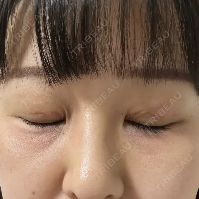 二重埋没 / 上まぶたの脂肪取り 共立美容外科 福岡院 DAY 2 メイン用