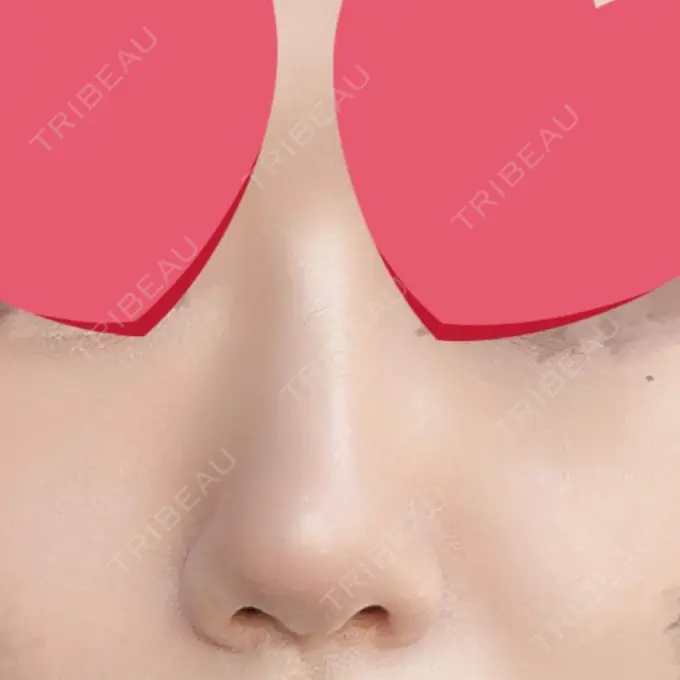 鼻尖形成（切開） / 下まぶたの脂肪取り / 真皮移植 LUHO（ルホ）美容外科 DAY 91 メイン用