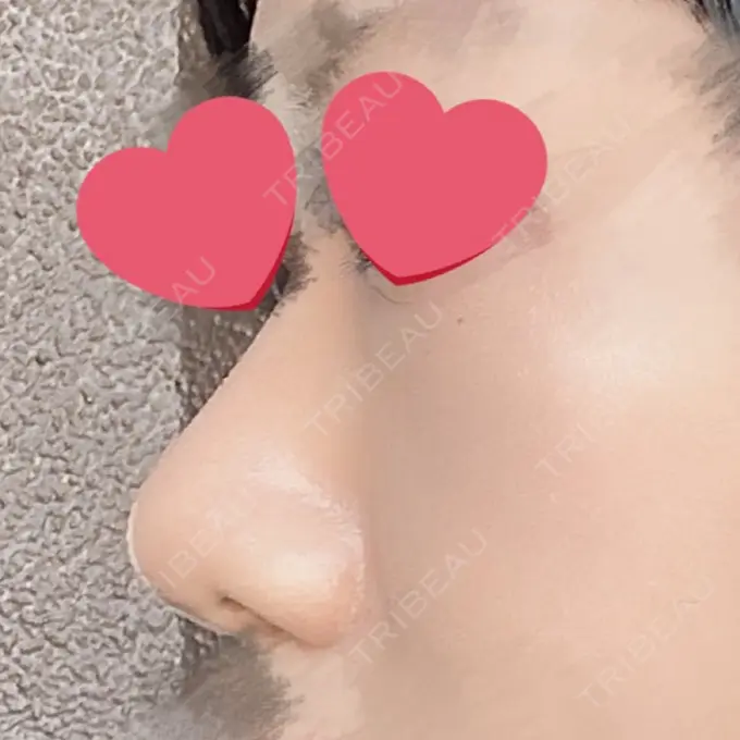 鼻尖形成（切開） / 下まぶたの脂肪取り / 真皮移植 LUHO（ルホ）美容外科 DAY 91 メイン用