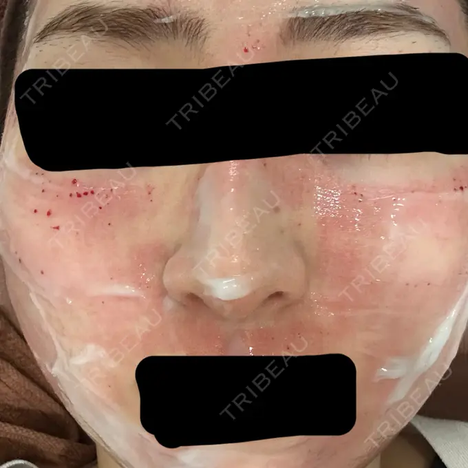 毛穴洗浄（ハイドラフェイシャルなど） / リジュラン / ポテンツァ ミケイ医院 AFTER メイン用