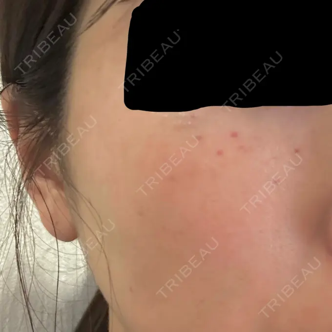 毛穴洗浄（ハイドラフェイシャルなど） / リジュラン / ポテンツァ ミケイ医院 DAY 2 メイン用