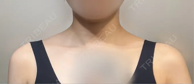 ボトックス（肩） ヴァージンクリニック 福岡天神院 DAY 7 メイン用