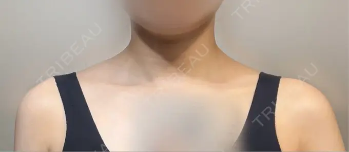 ボトックス（肩） ヴァージンクリニック 福岡天神院 DAY 14 メイン用