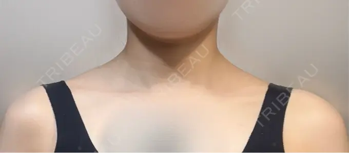 ボトックス（肩） ヴァージンクリニック 福岡天神院 AFTER メイン用