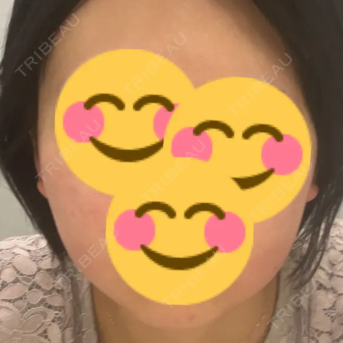 その他（肌） / RF（高周波）たるみ治療 / その他（輪郭） ルラ美容クリニック 仙台院 / ルラスキンクリニック 仙台院 AFTER メイン用