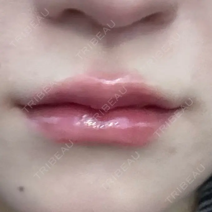 ヒアルロン酸注入（唇） 新未来クリニック AFTER メイン用